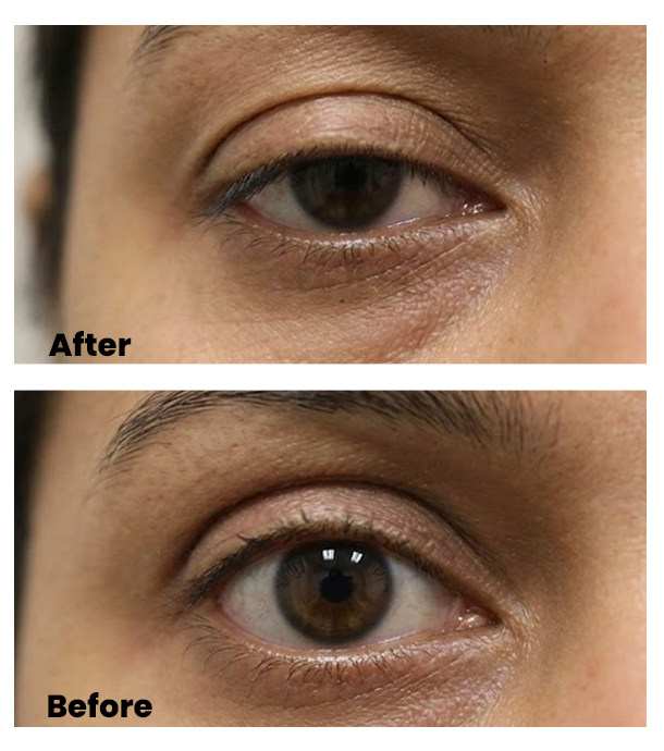 Ptosis Surgery